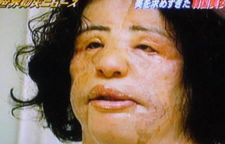 Hang Mioku korean plastic surgery injected cooking oil into face
