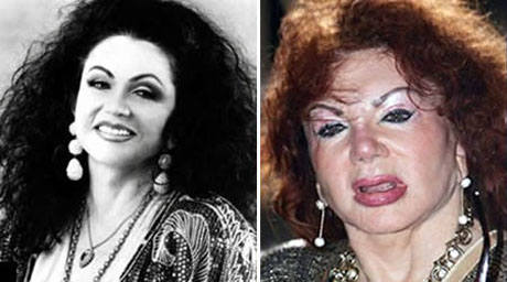 Jackie Stallone, facelift, brow lift, cheek implants, nose job
